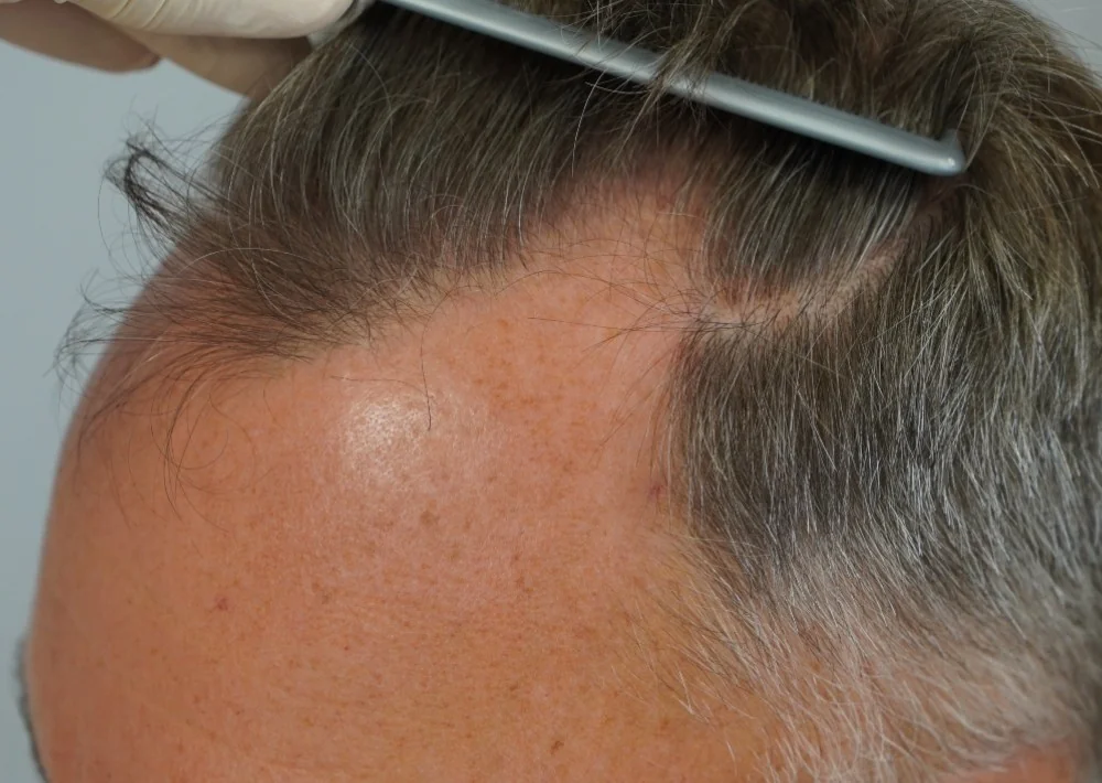 Before hair restoration: Male patient underwent FUE procedure of 1175 grafts.