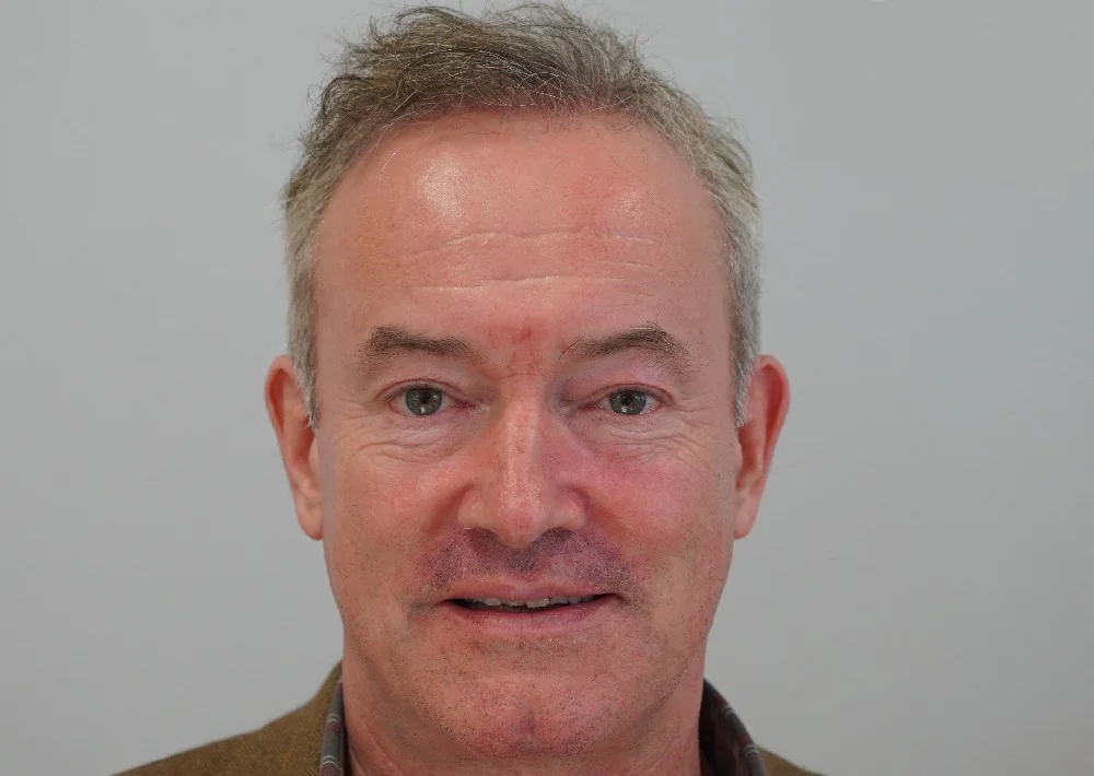 After hair restoration: Male patient underwent FUT procedure of 2847 grafts.
