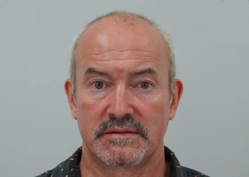 Before hair restoration: Male patient underwent FUT procedure of 2847 grafts.
