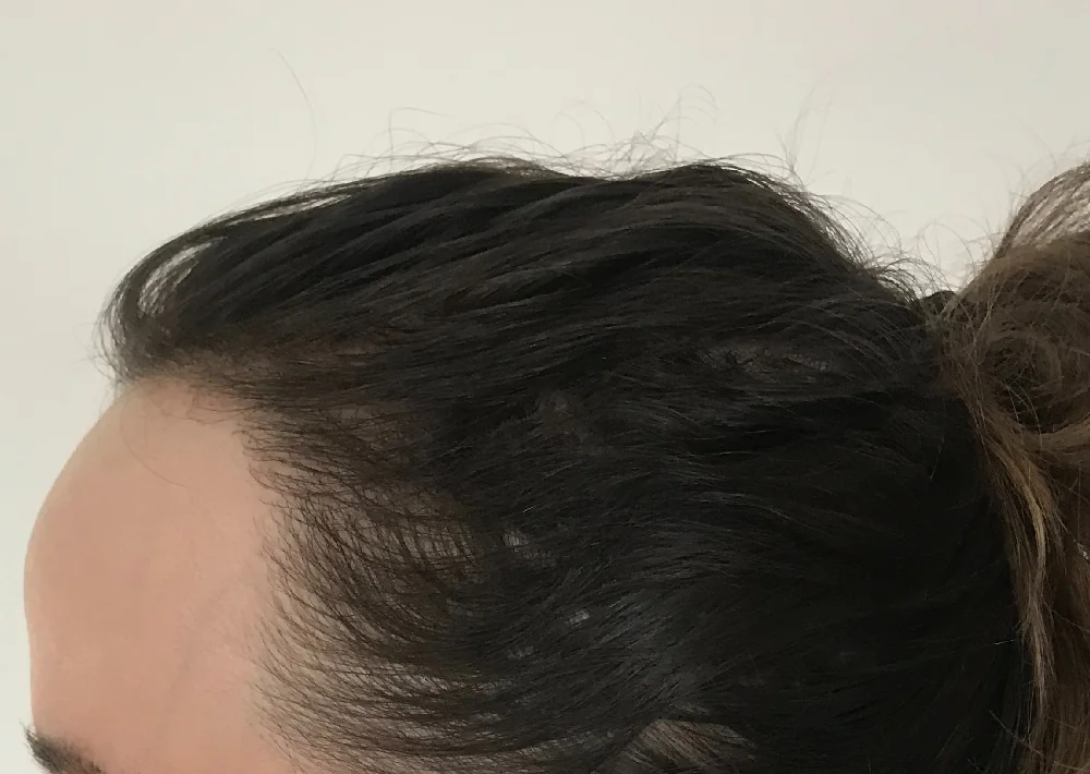 After hair restoration: Female patient underwent FUT procedure of 1683 grafts.