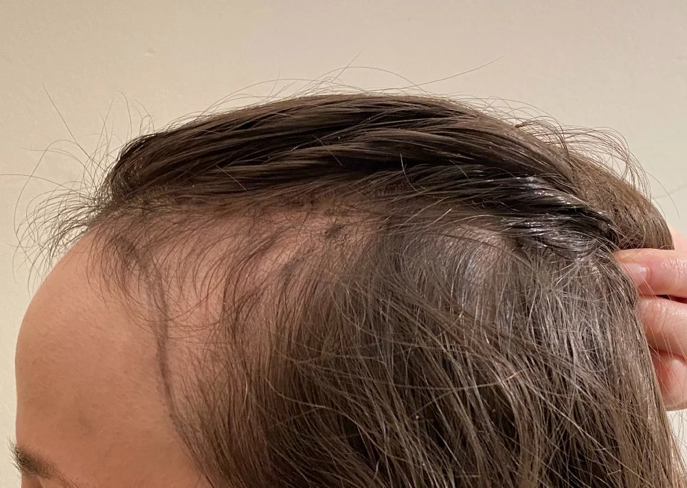 Before hair restoration: Female patient underwent FUT procedure of 1683 grafts.