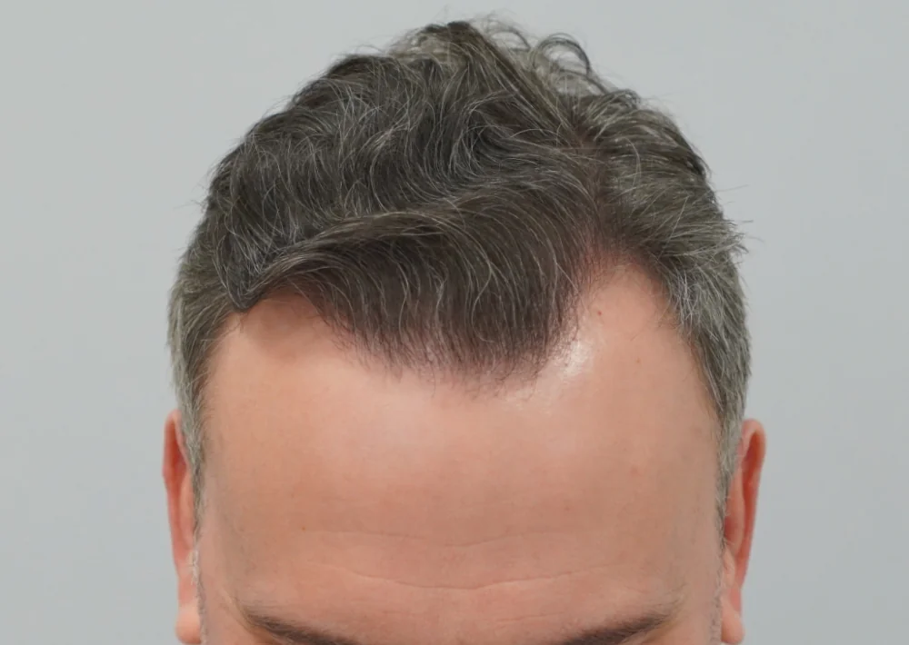 After hair restoration: Male patient underwent FUE procedure of 1609 grafts.