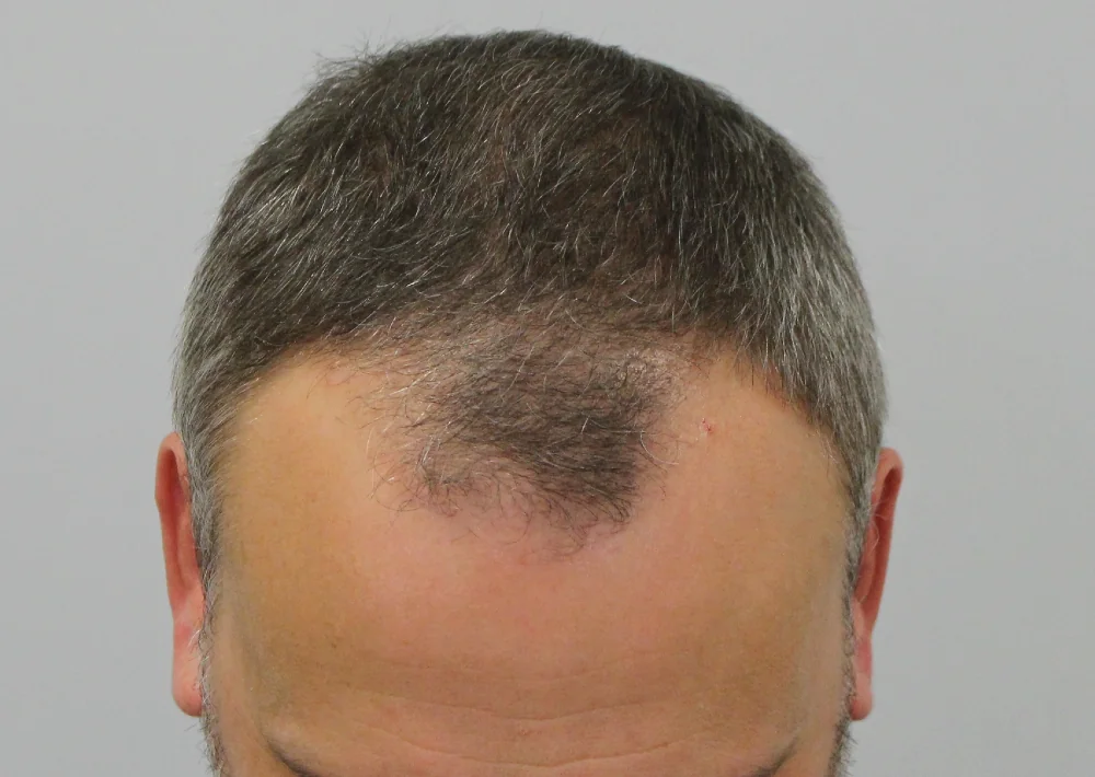 Before hair restoration: Male patient underwent FUE procedure of 1609 grafts.