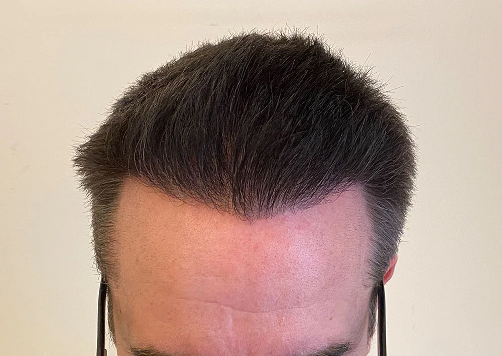 After hair restoration: Male patient underwent FUE procedure of 2122 grafts.