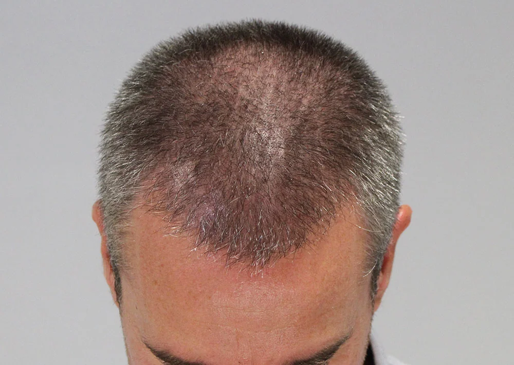 Before hair restoration: Male patient underwent FUE procedure of 2122 grafts.