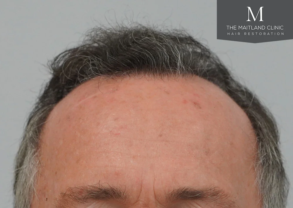 After hair restoration: Male patient underwent FUT procedure of 3383 grafts.
