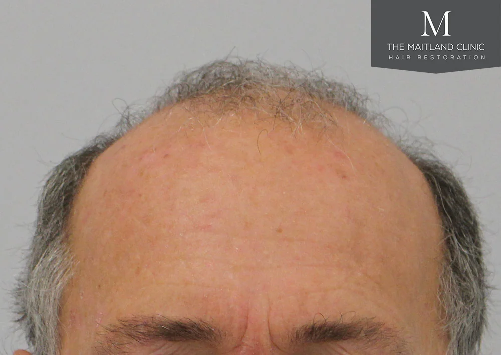 Before hair restoration: Male patient underwent FUT procedure of 3383 grafts.