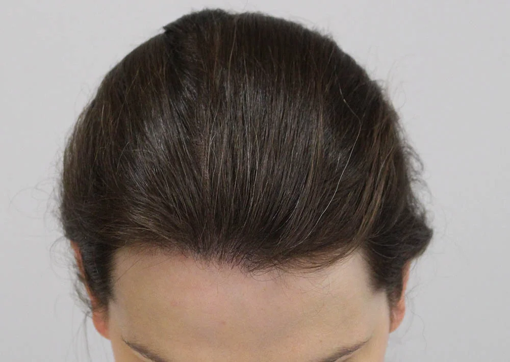 After hair restoration: Female patient underwent FUT procedure of 2061 grafts.