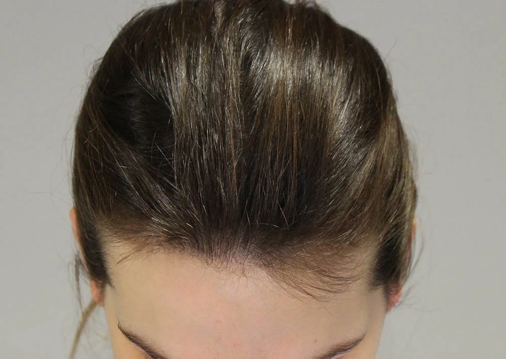 Before hair restoration: Female patient underwent FUT procedure of 2061 grafts.