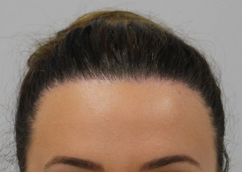 After hair restoration: Female patient underwent a repair procedure of 1870 grafts.