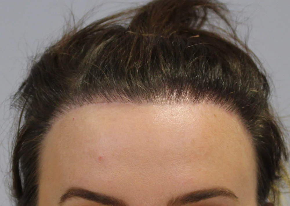 Before hair restoration: Female patient underwent a repair procedure of 1870 grafts.