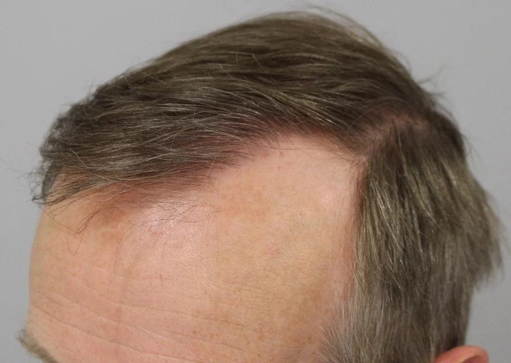After hair restoration: Male patient underwent FUE procedure of 2005 grafts.