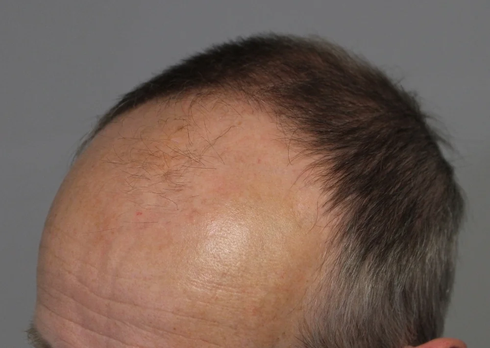 Before hair restoration: Male patient underwent FUE procedure of 2005 grafts.