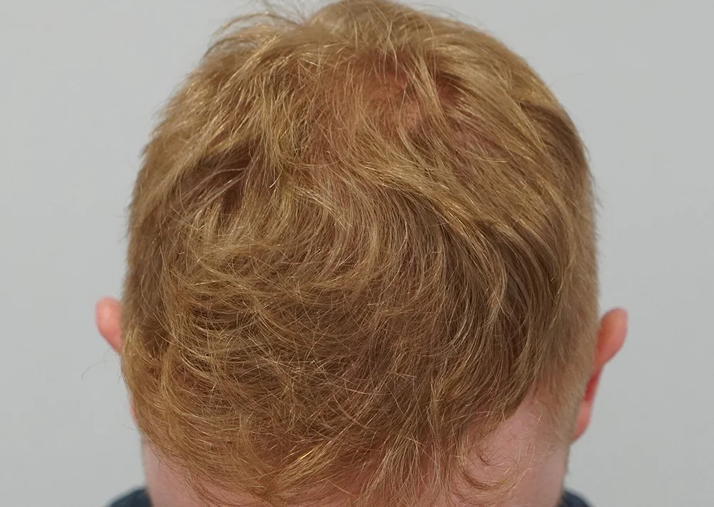 After hair restoration: Male patient underwent FUE procedure of 1500 grafts.
