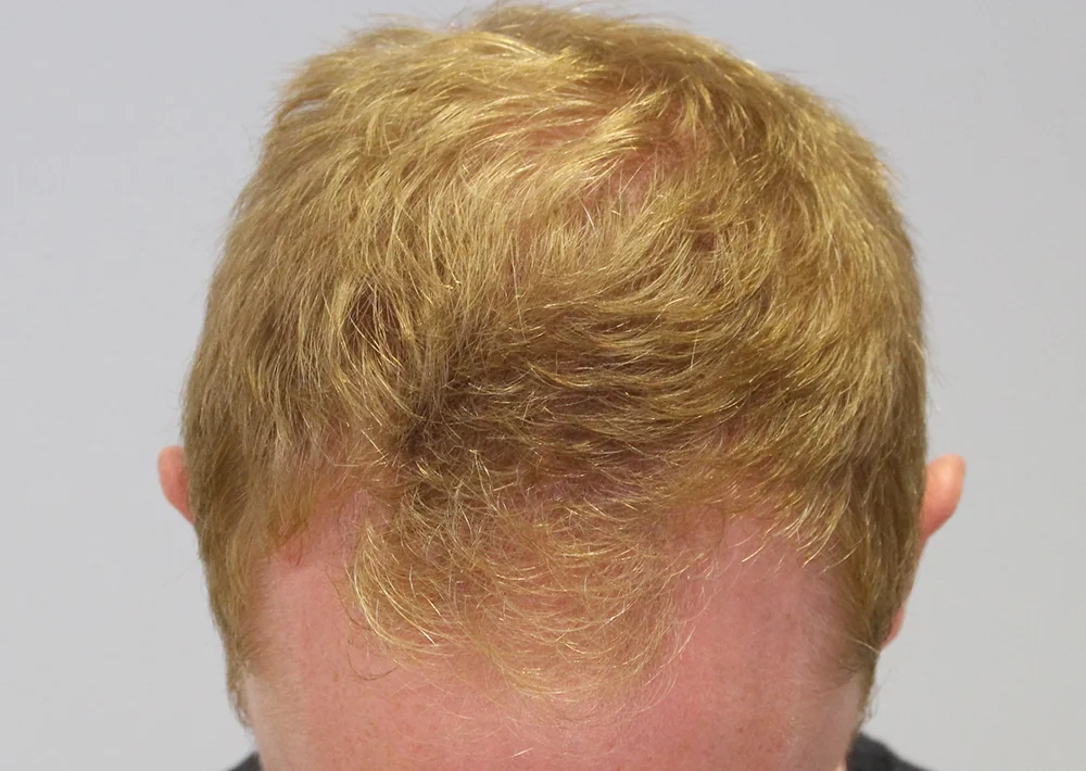 Before hair restoration: Male patient underwent FUE procedure of 1500 grafts.