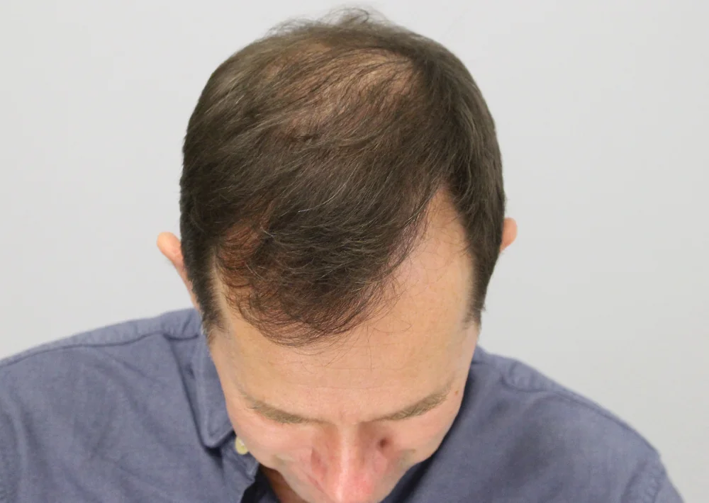 After hair restoration: Male patient underwent FUE procedure of 2128 grafts.