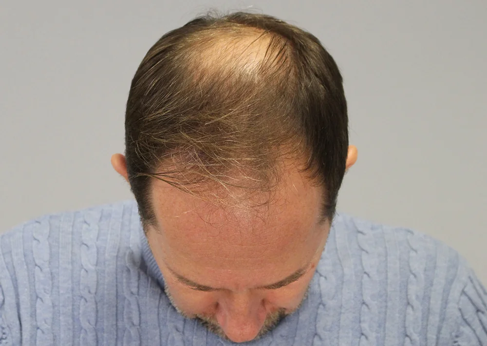 Before hair restoration: Male patient underwent FUE procedure of 2128 grafts.