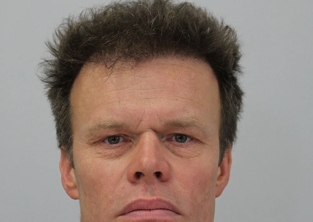 After hair restoration: Male patient underwent a repair procedure of 1611 grafts.