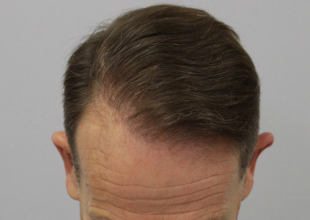 After hair restoration: Male patient underwent FUE procedure of 1810 grafts.