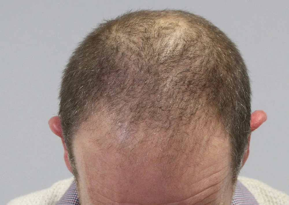 Before hair restoration: Male patient underwent FUE procedure of 1810 grafts.