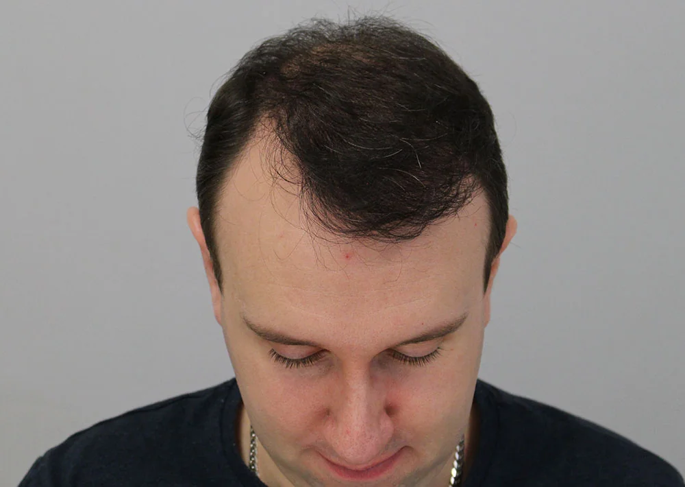 After hair restoration: Male patient underwent FUT procedure of 3809 grafts.