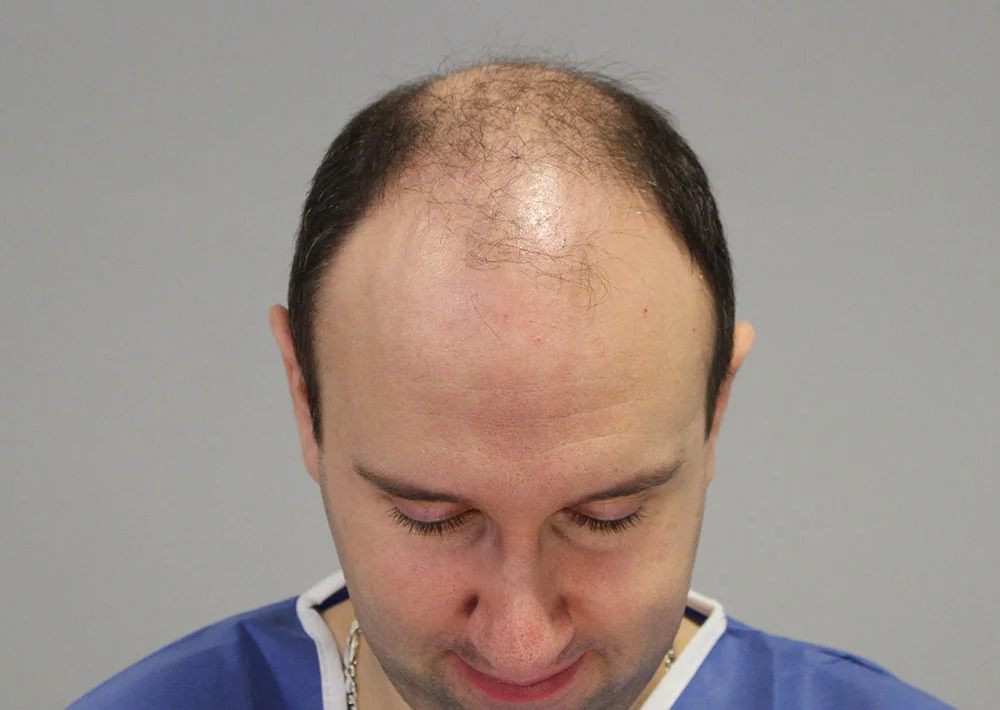 Before hair restoration: Male patient underwent FUT procedure of 3809 grafts.