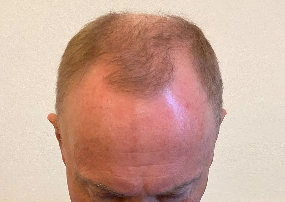 After hair restoration: Male patient underwent FUE procedure of 1506 grafts.
