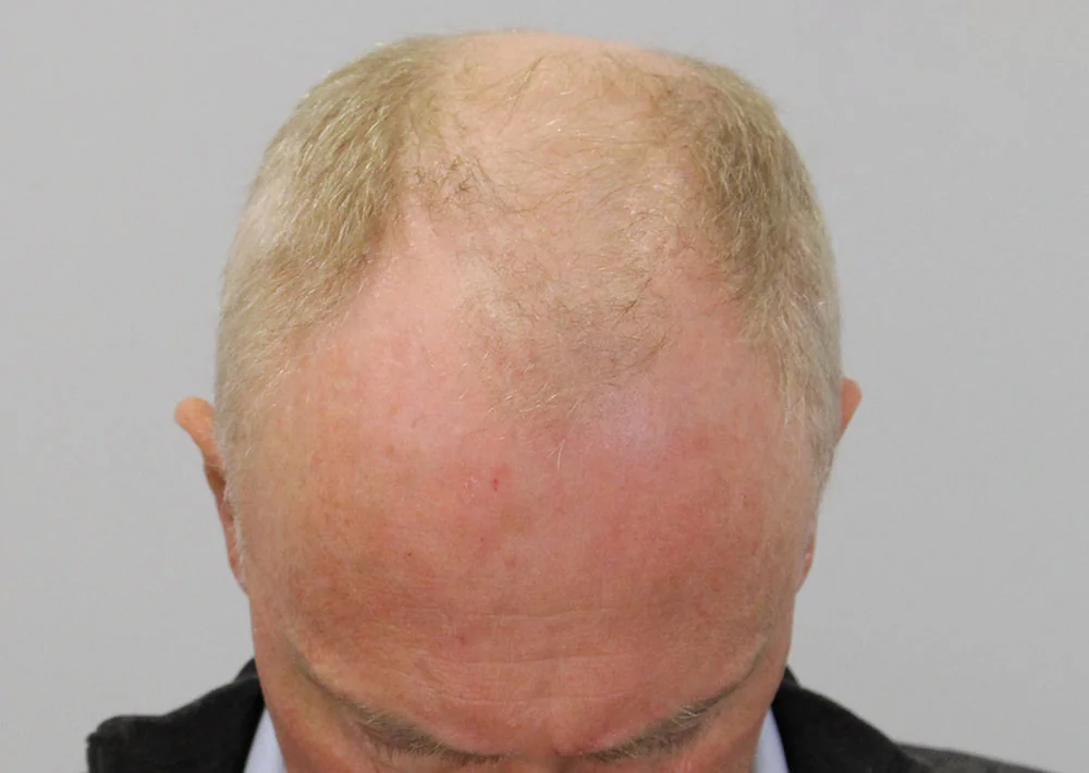 Before hair restoration: Male patient underwent FUE procedure of 1506 grafts.