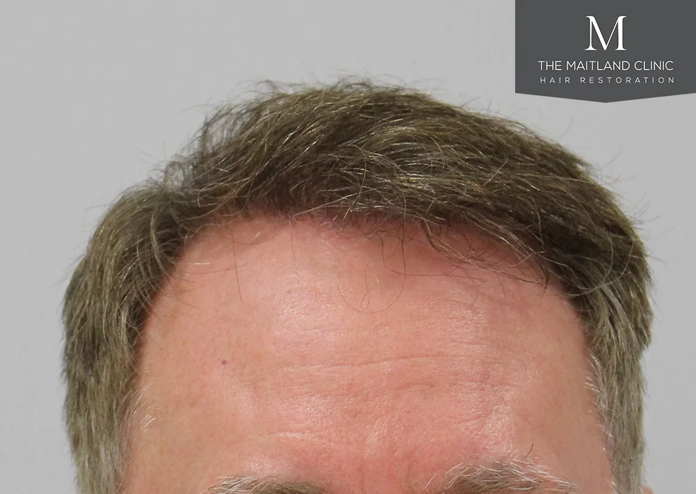After hair restoration: Male patient underwent FUT procedure of 3100 grafts.