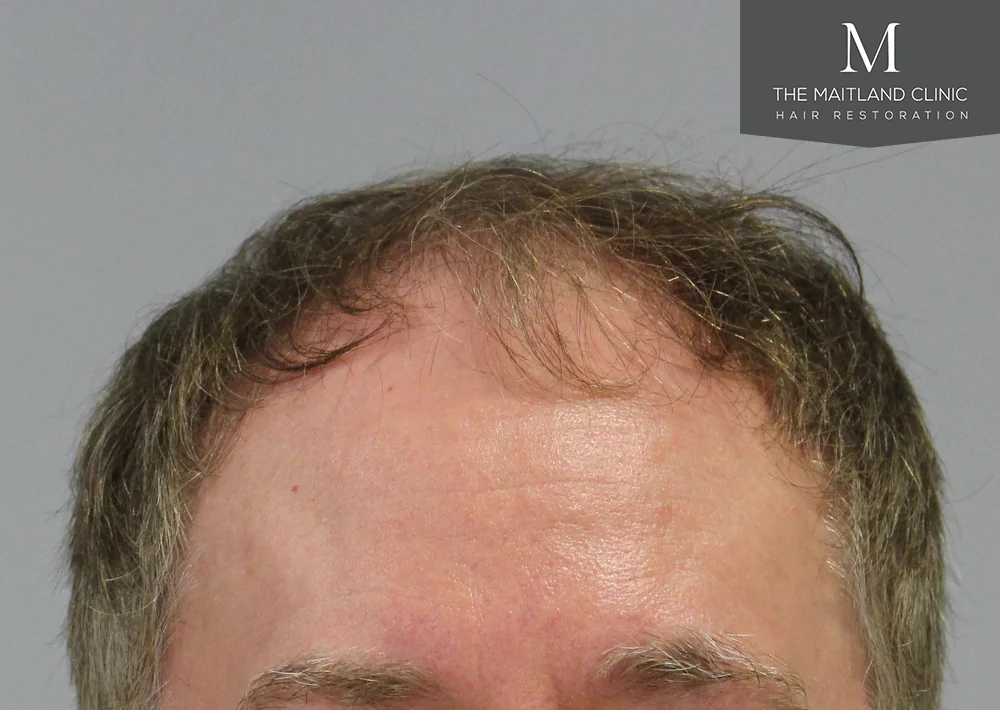 Before hair restoration: Male patient underwent FUT procedure of 3100 grafts.
