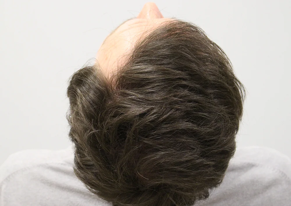 After hair restoration: Male patient underwent FUE procedure of 2290 grafts.