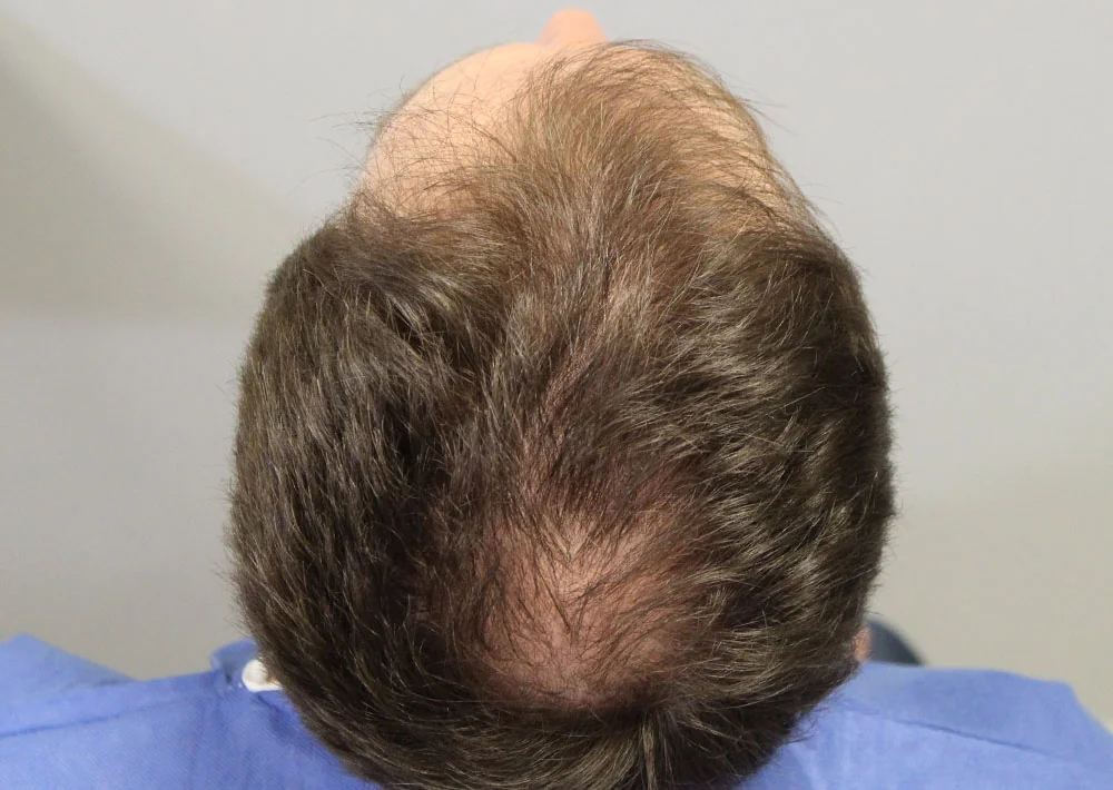 Before hair restoration: Male patient underwent FUE procedure of 2290 grafts.