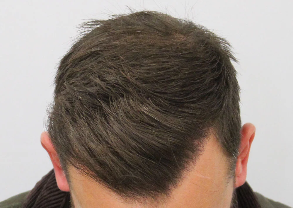 After hair restoration: Male patient underwent FUE procedure of 2009 grafts.
