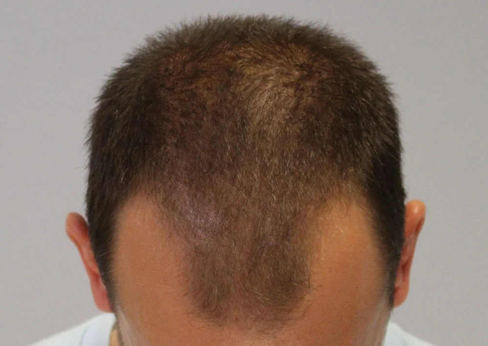 Before hair restoration: Male patient underwent FUE procedure of 2009 grafts.