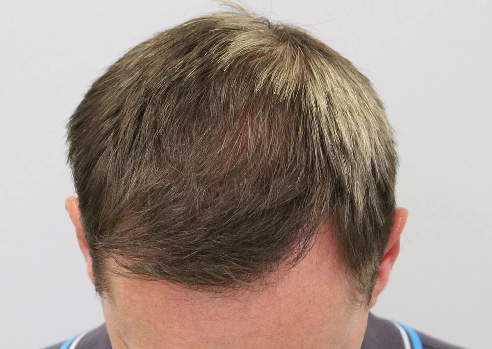 After hair restoration: Male patient underwent FUE procedure of 1921 grafts.