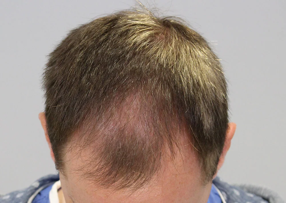 Before hair restoration: Male patient underwent FUE procedure of 1921 grafts.