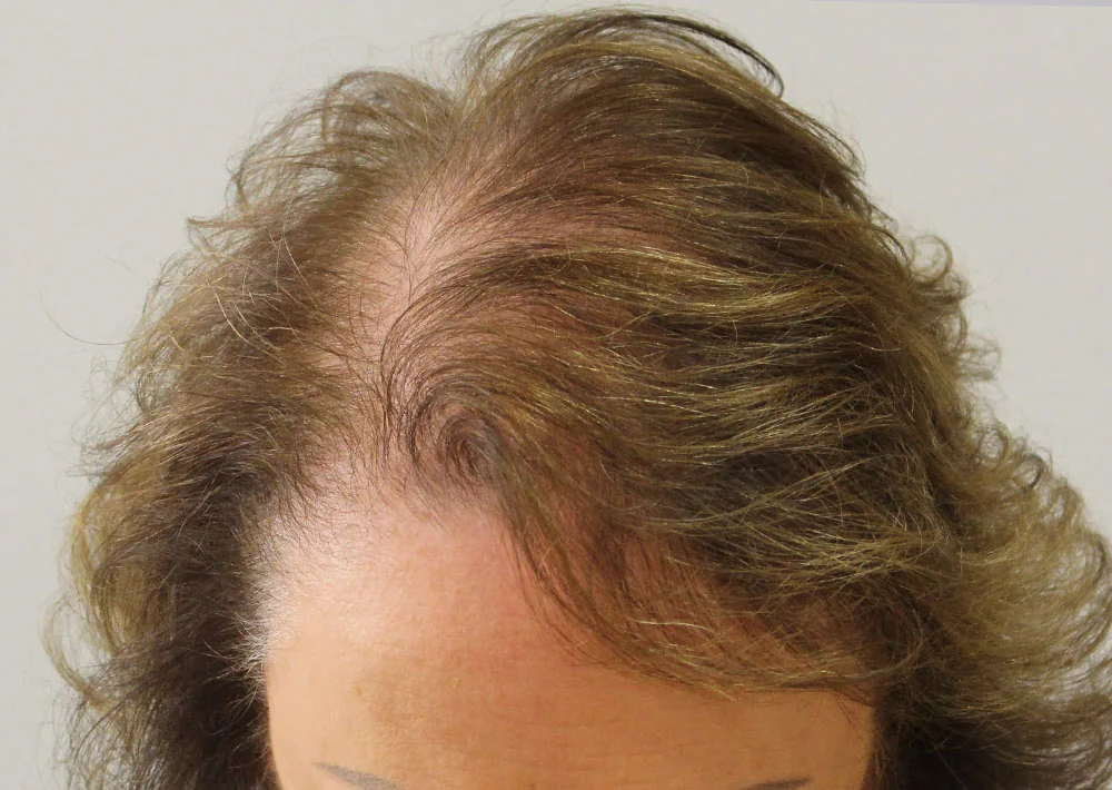 After hair restoration: Female patient underwent PRP non-surgical procedure.