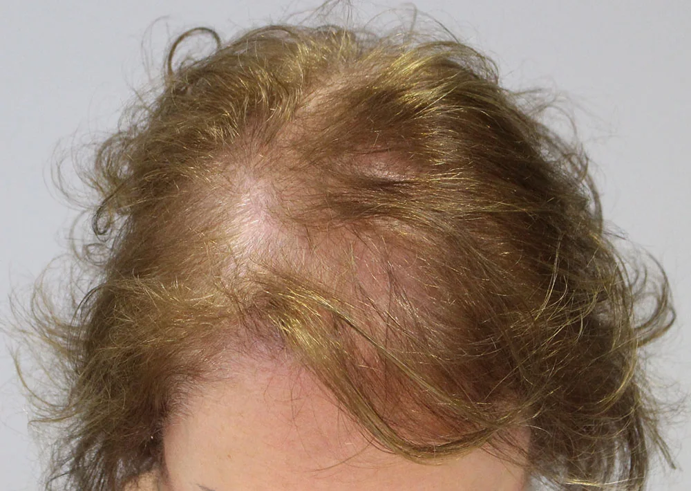 Before hair restoration: Female patient underwent PRP non-surgical procedure.