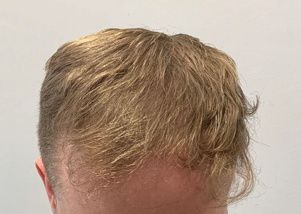 After hair restoration: Male patient took hair loss medication.