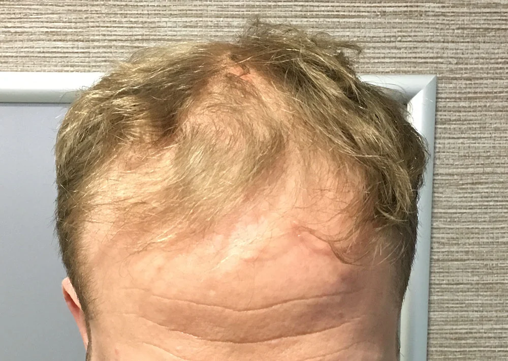 Before hair restoration: Male patient took hair loss medication.
