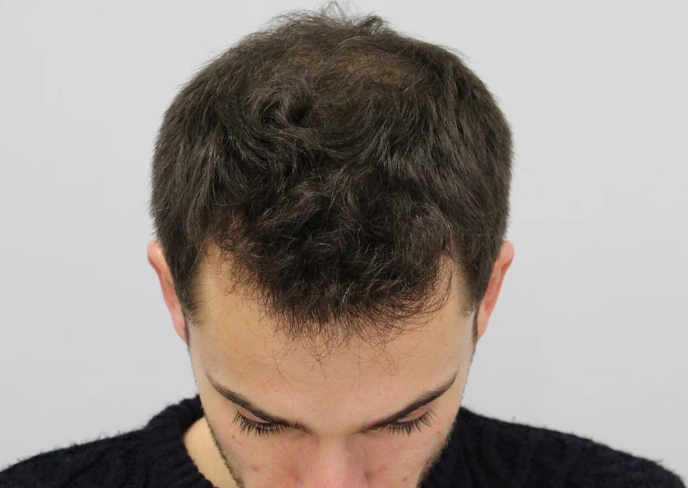After hair restoration: Male patient underwent FUT procedure of 2387 grafts.