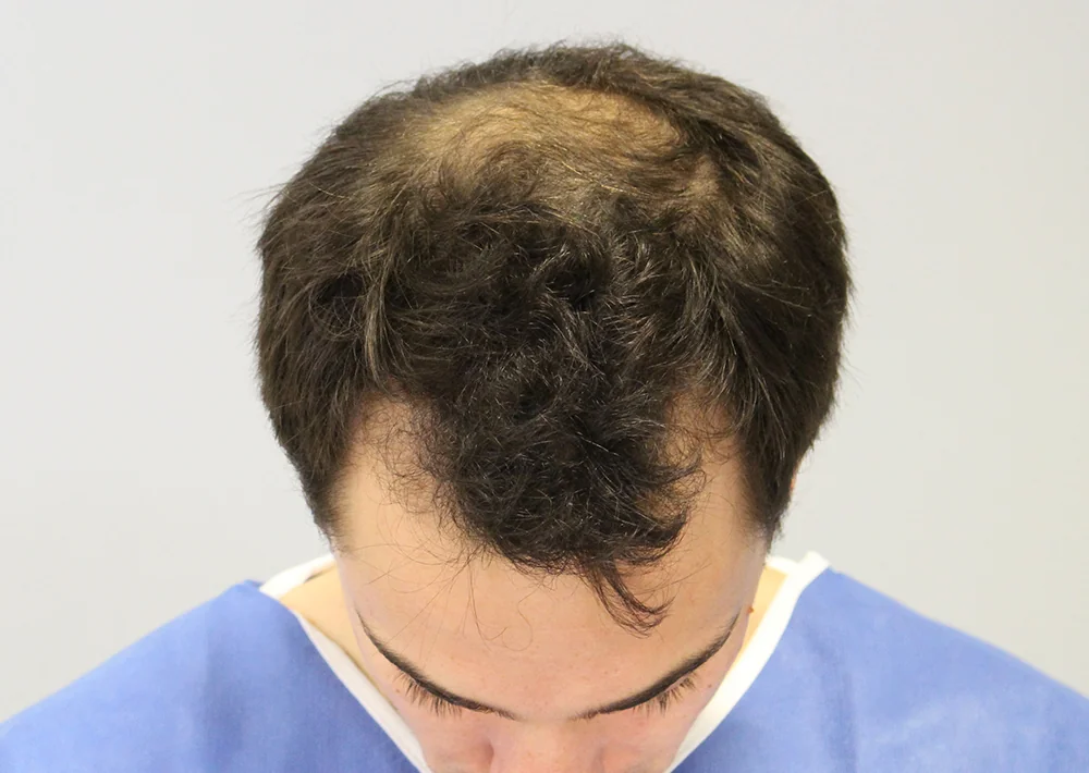 Before hair restoration: Male patient underwent FUT procedure of 2387 grafts.