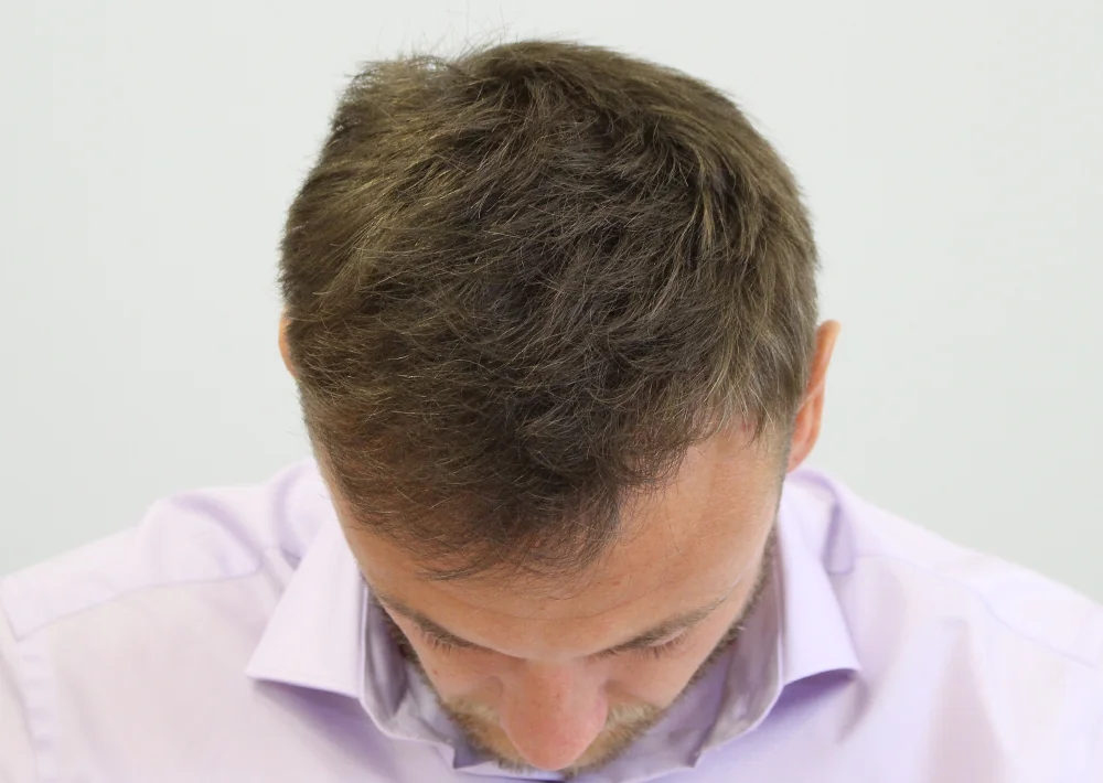 After hair restoration: Male patient underwent FUE procedure of 1632 grafts.