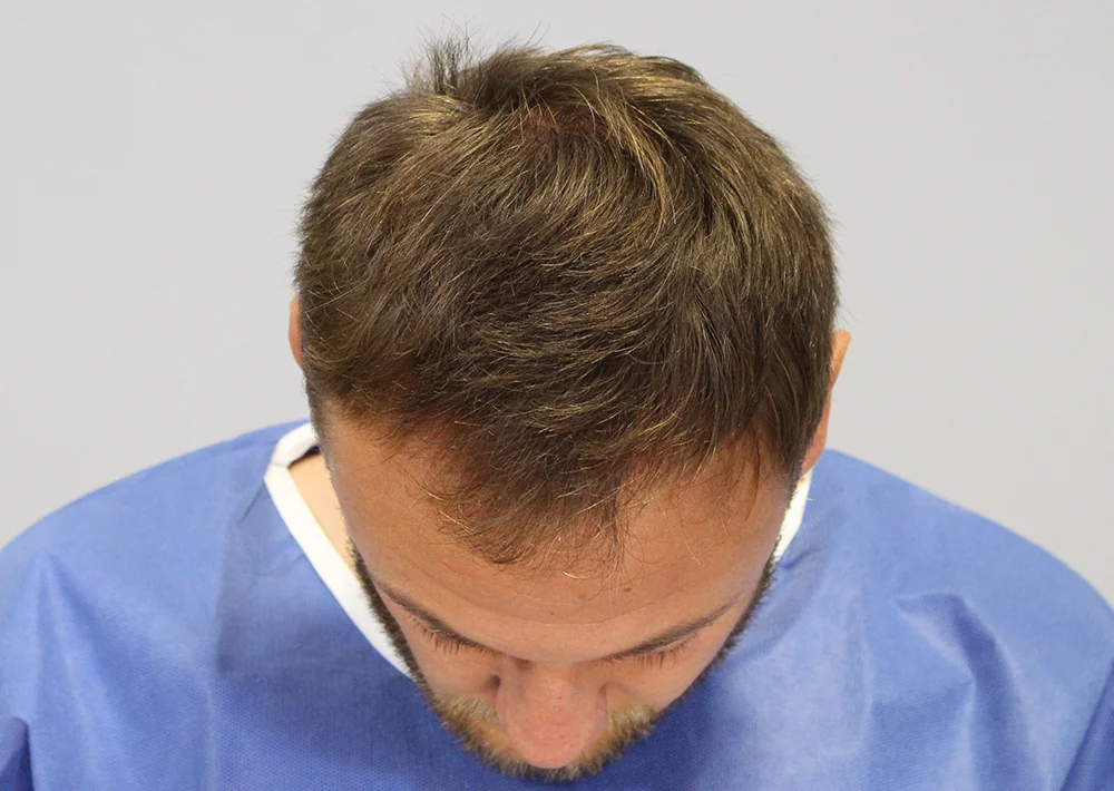 Before hair restoration: Male patient underwent FUE procedure of 1632 grafts.