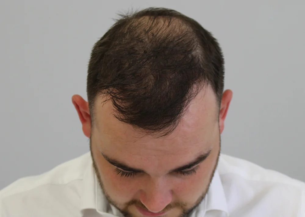 After hair restoration: Male patient underwent FUE procedure of 1846 grafts.