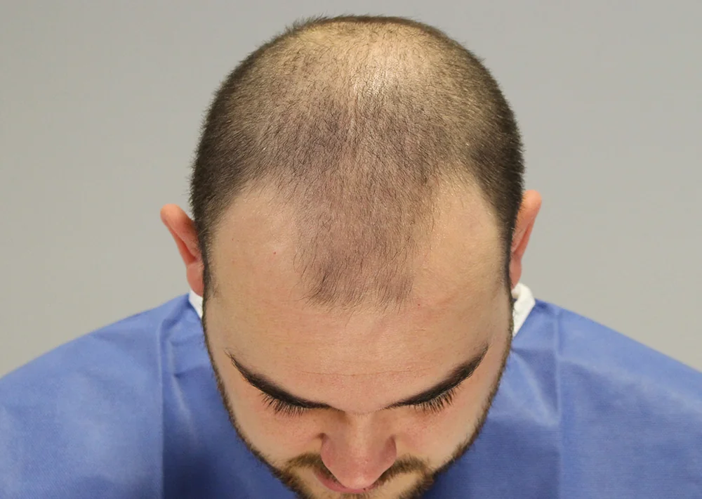Before hair restoration: Male patient underwent FUE procedure of 1846 grafts.