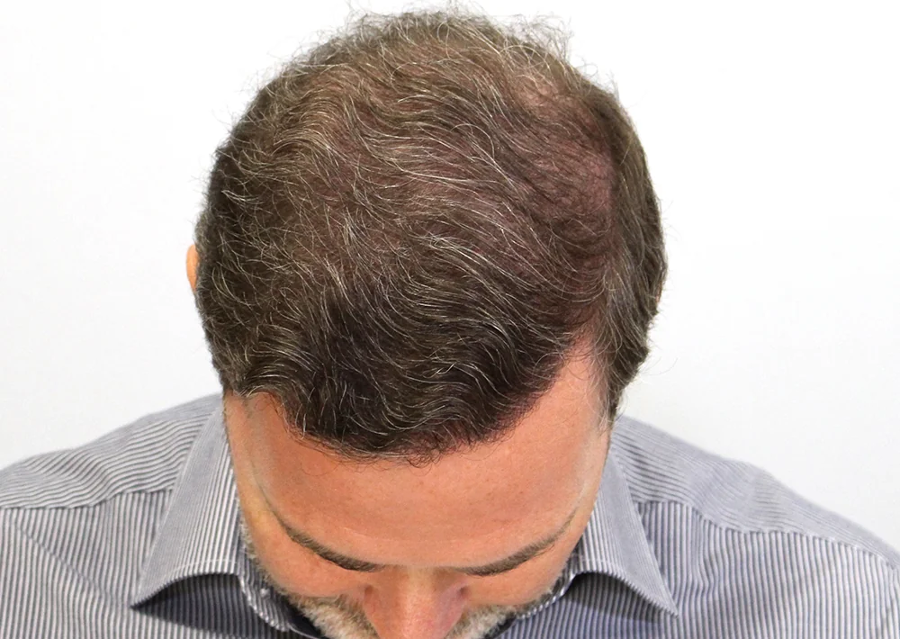 After hair restoration: Male patient underwent PRP non-surgical procedure.