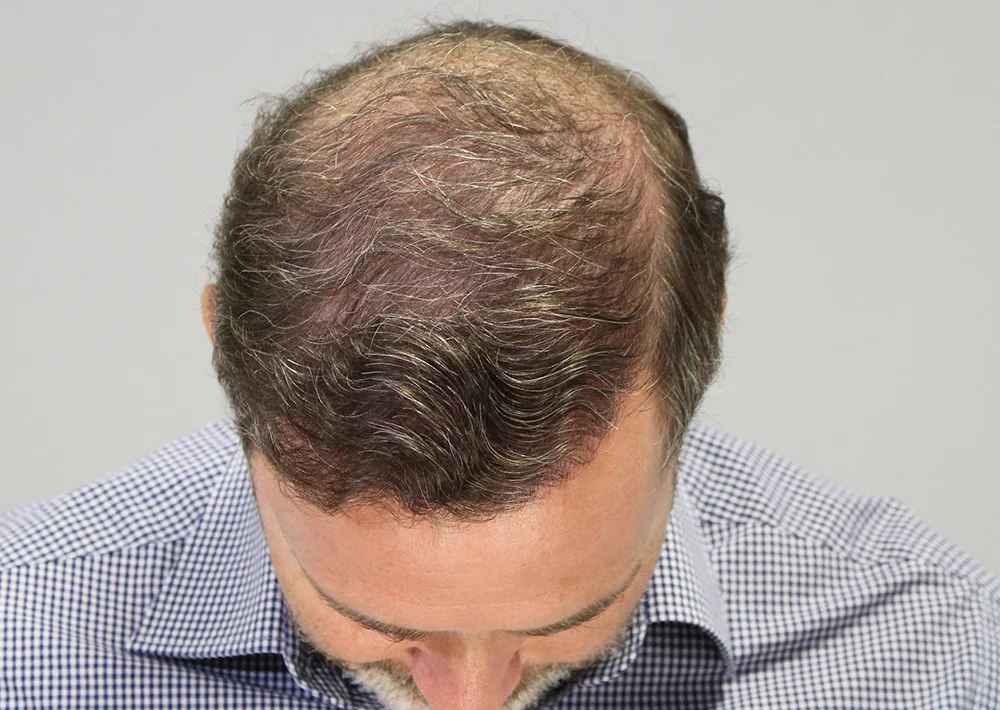 Before hair restoration: Male patient underwent PRP non-surgical procedure.