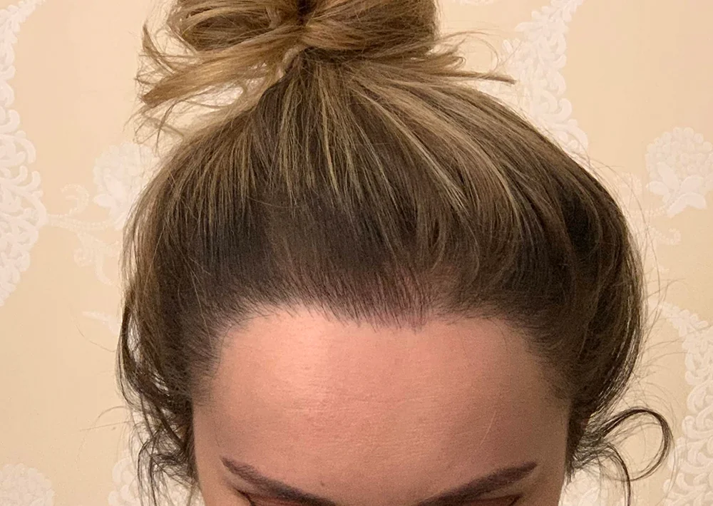 After hair restoration: Female patient underwent FUT procedure of 1875 grafts.