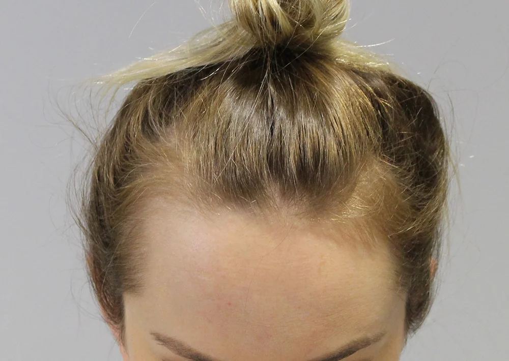 Before hair restoration: Female patient underwent FUT procedure of 1875 grafts.
